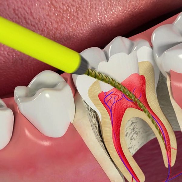 endodontia-3