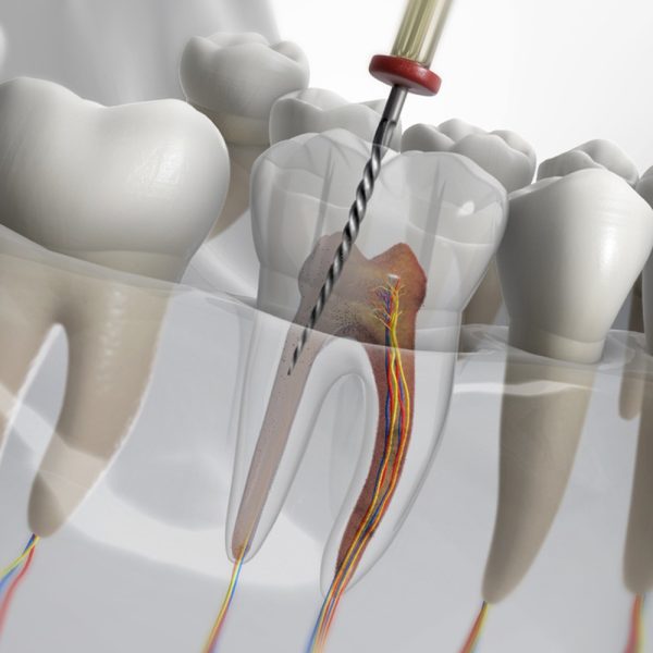 endodontia-4