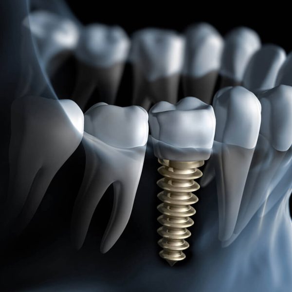 implante-dentario-2