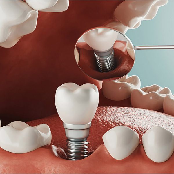 implante-dentario-3