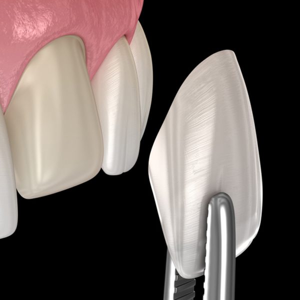 lentes-de-contato-dental-1