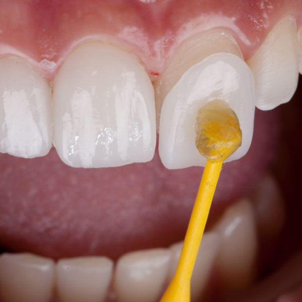 lentes-de-contato-dental-2