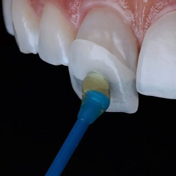 lentes-de-contato-dental-3